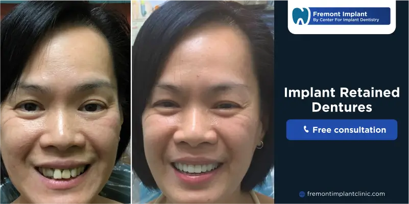 implant retained dentures