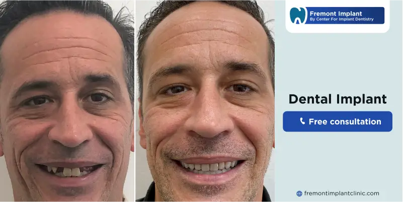 what are dental implants made of?